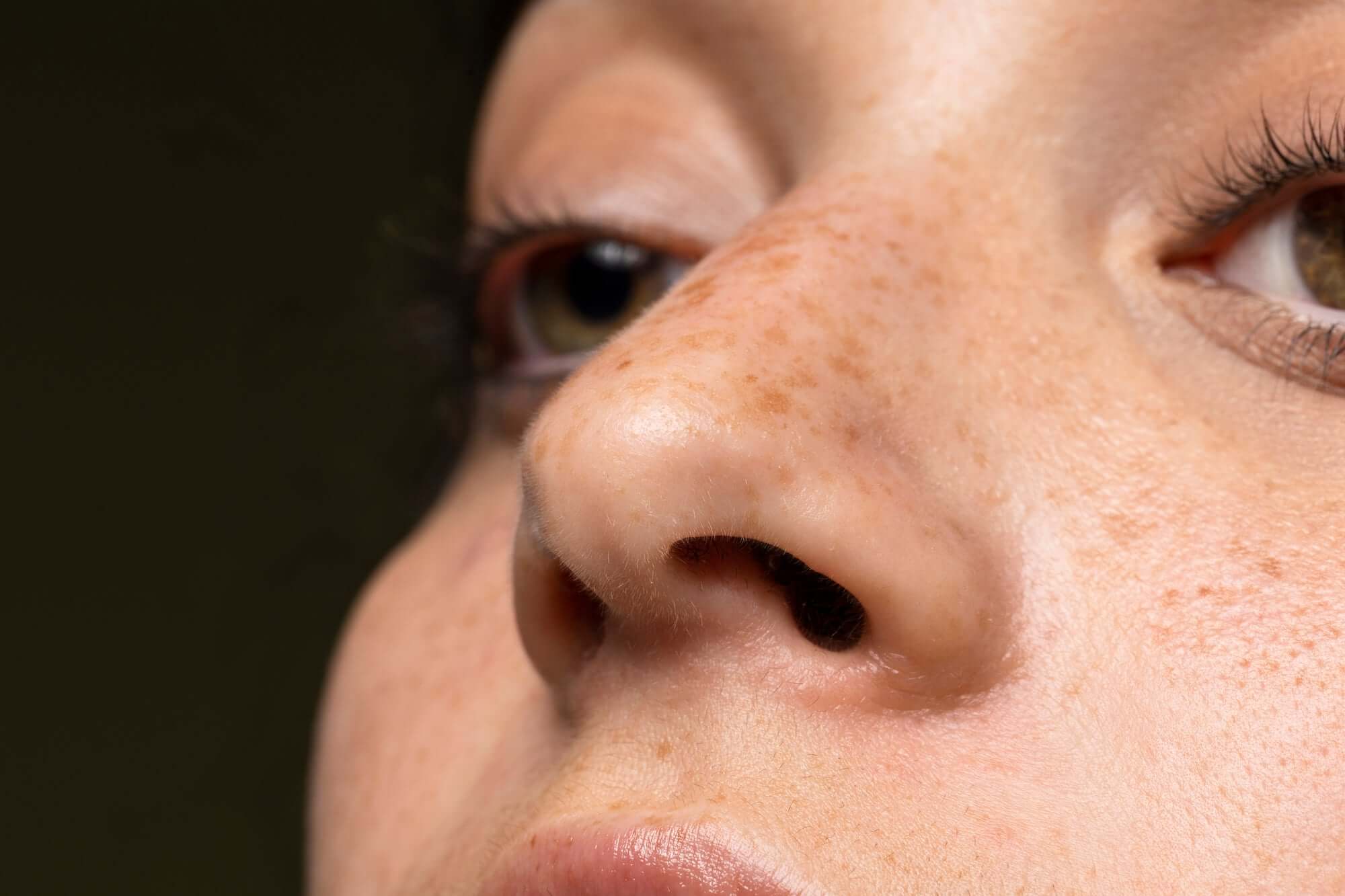 The Unseen Culprit: Unveiling the Connection Between UV Rays and Dark Spots