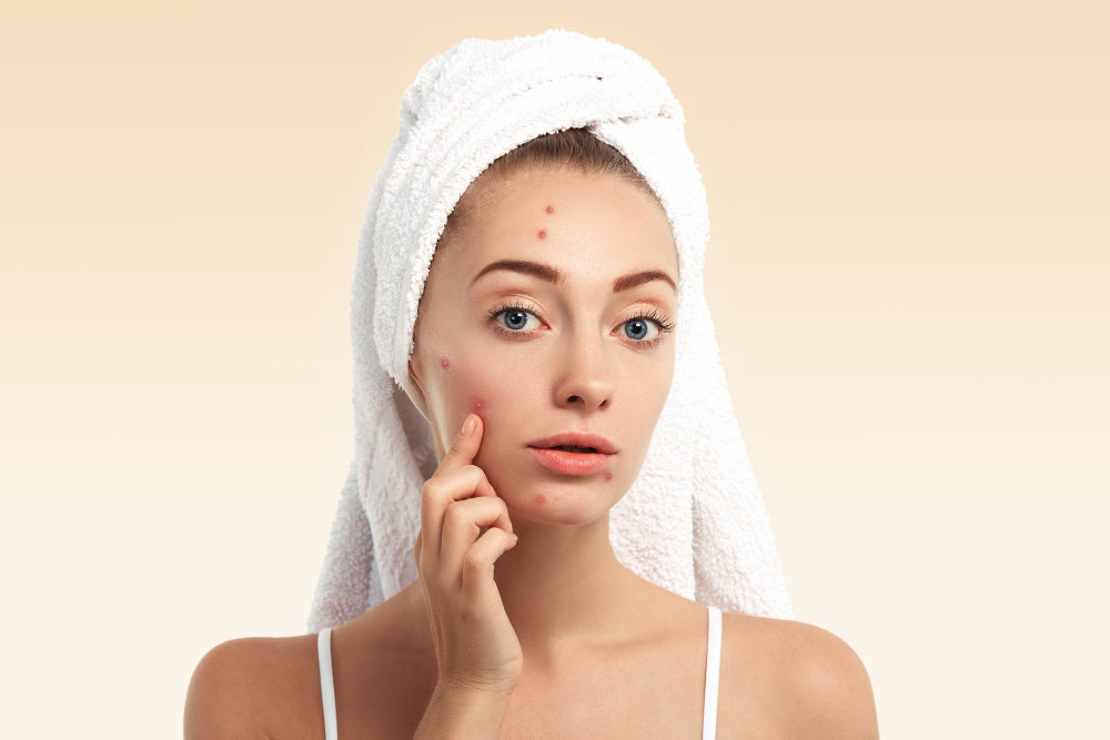 How an Imbalanced Gut Can Trigger Skin Problems Like Acne & Eczema