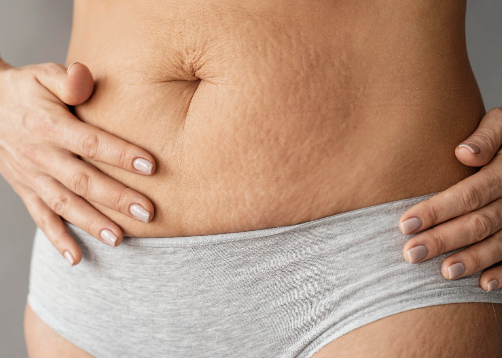 Prevent Stretch Marks Naturally with Hyaluronic Acid