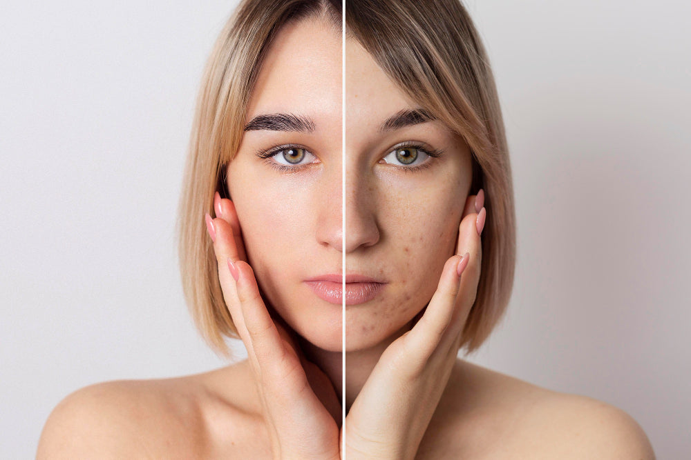 Why Your Skin Barrier Matters for Acne and How to Protect It