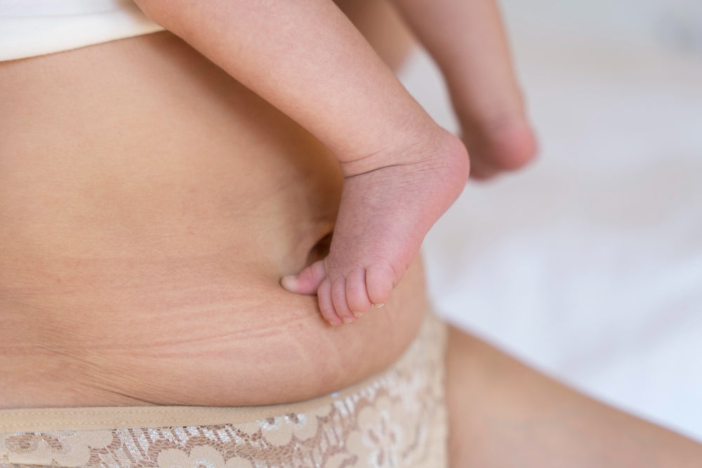 How Collagen Supplements May Help Reduce Stretch Marks