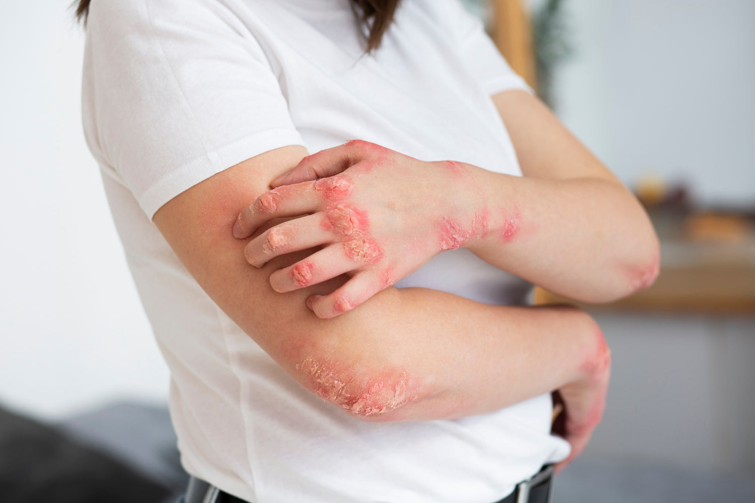 How Moringa Can Help with Eczema Relief Naturally