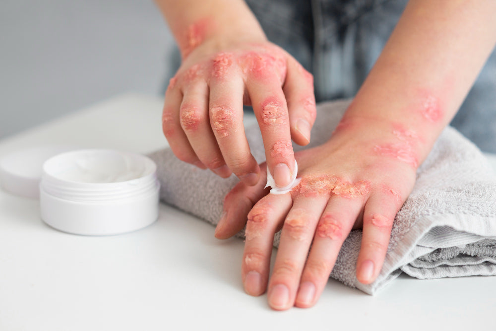 Eczema Relief: Proven Ways to Soothe, Heal, and Prevent Flare-Ups