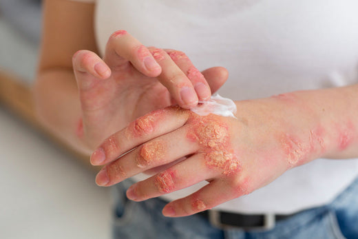 Riboflavin Deficiency: Symptoms, Causes, and How to Fix It