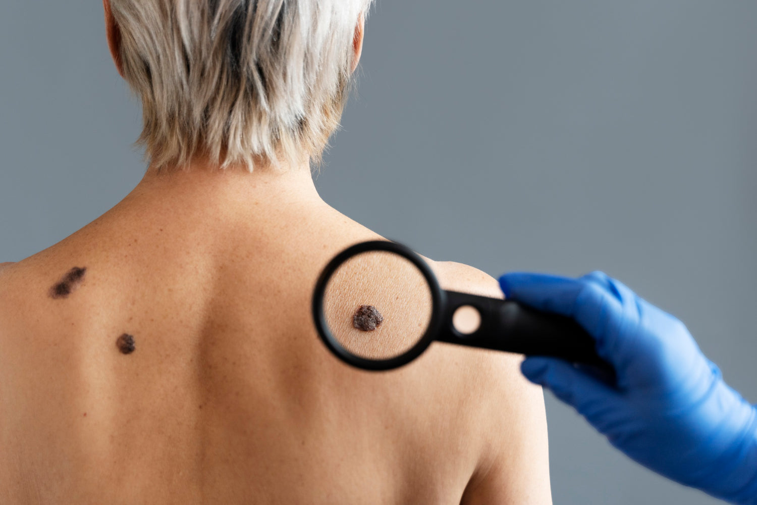 Top Risk Factors for Melanoma: Are You at High Risk?