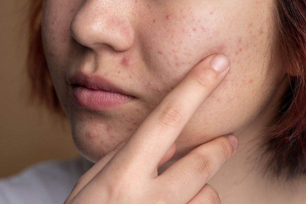 How Retinol Can Affect Your Skin: Acne, Breakouts & More