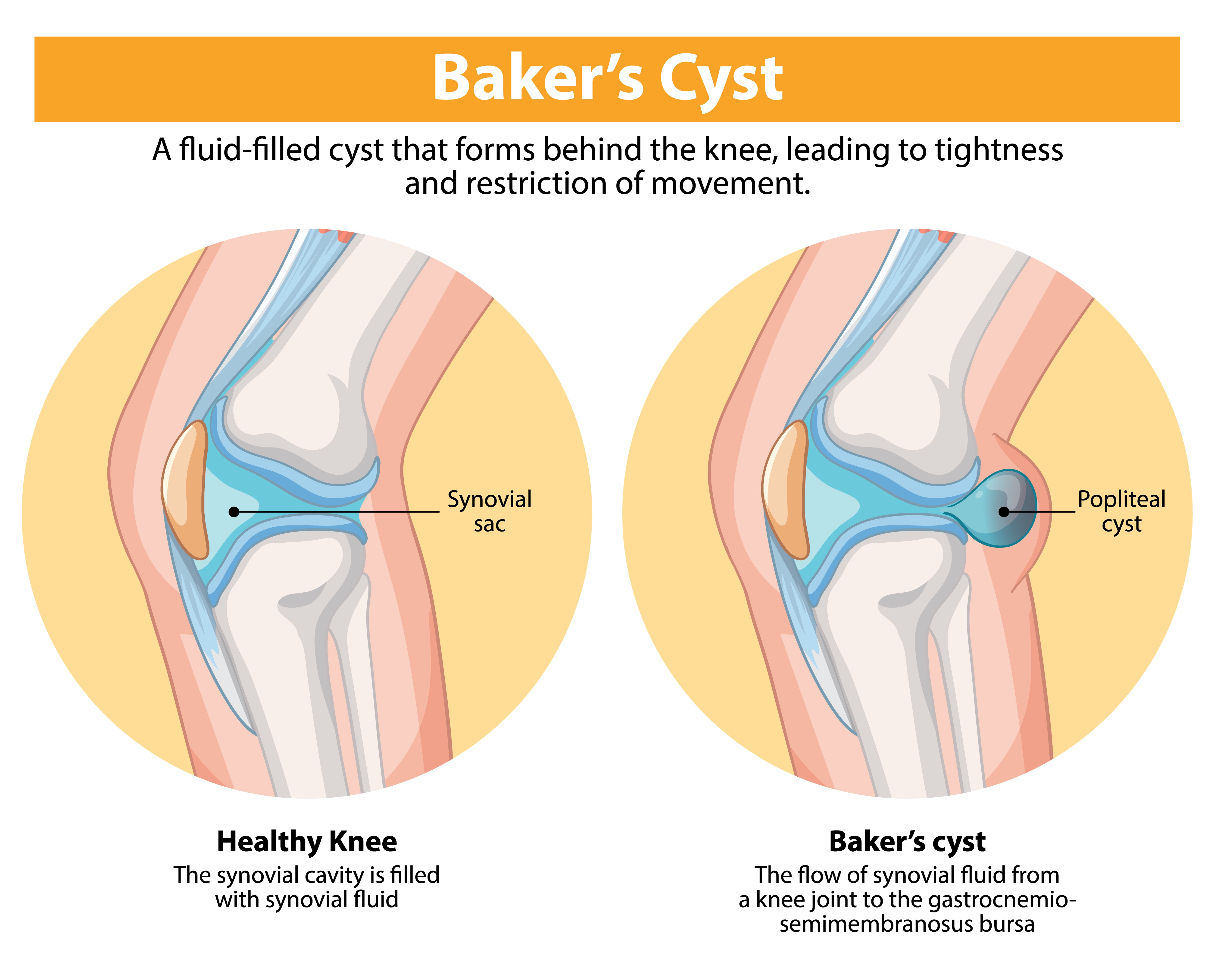 Understanding Baker Cyst: Symptoms, Causes & Treatment Explained Simply
