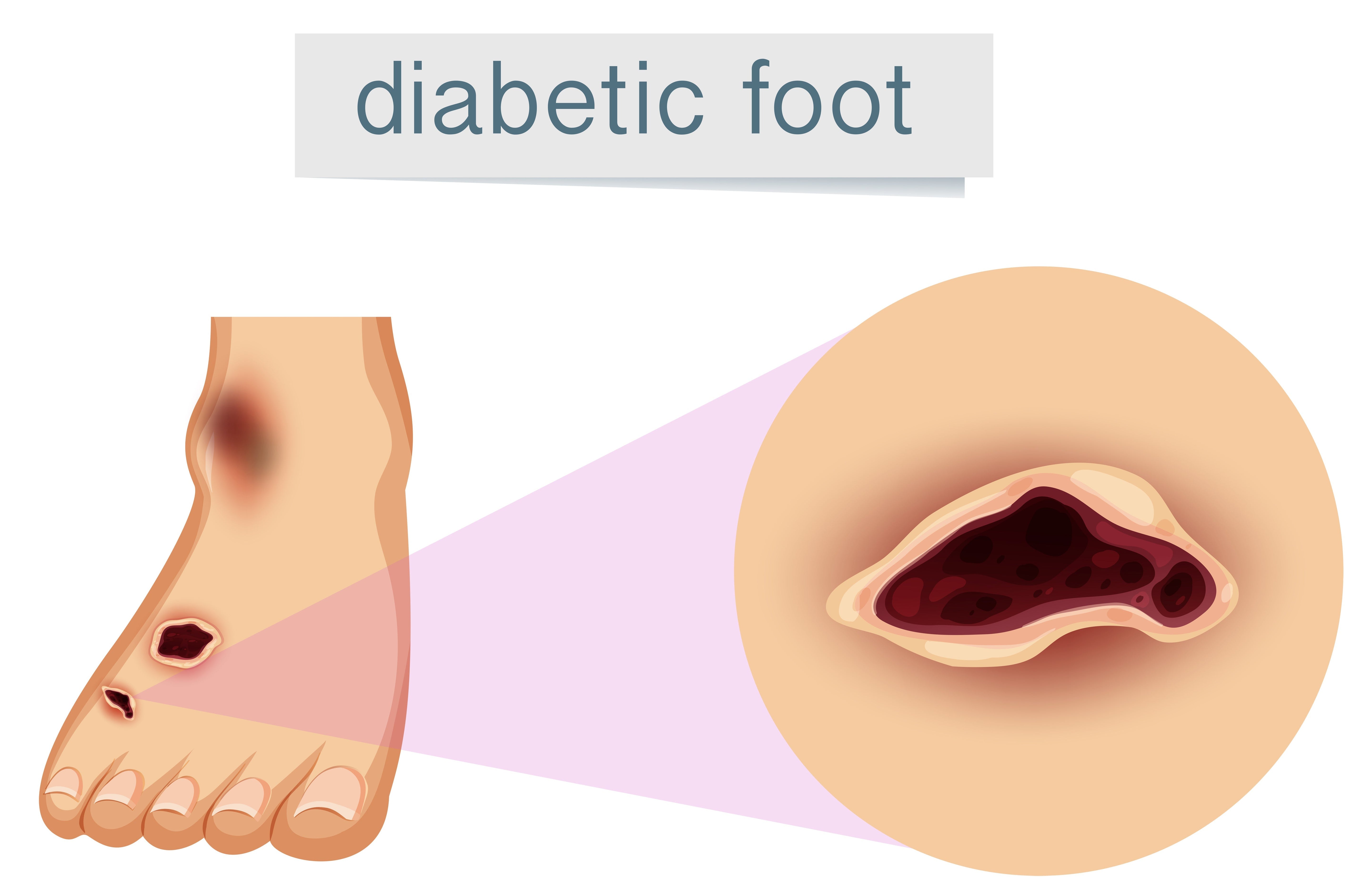 Diabetes and Wound Healing: How to Speed Up Recovery