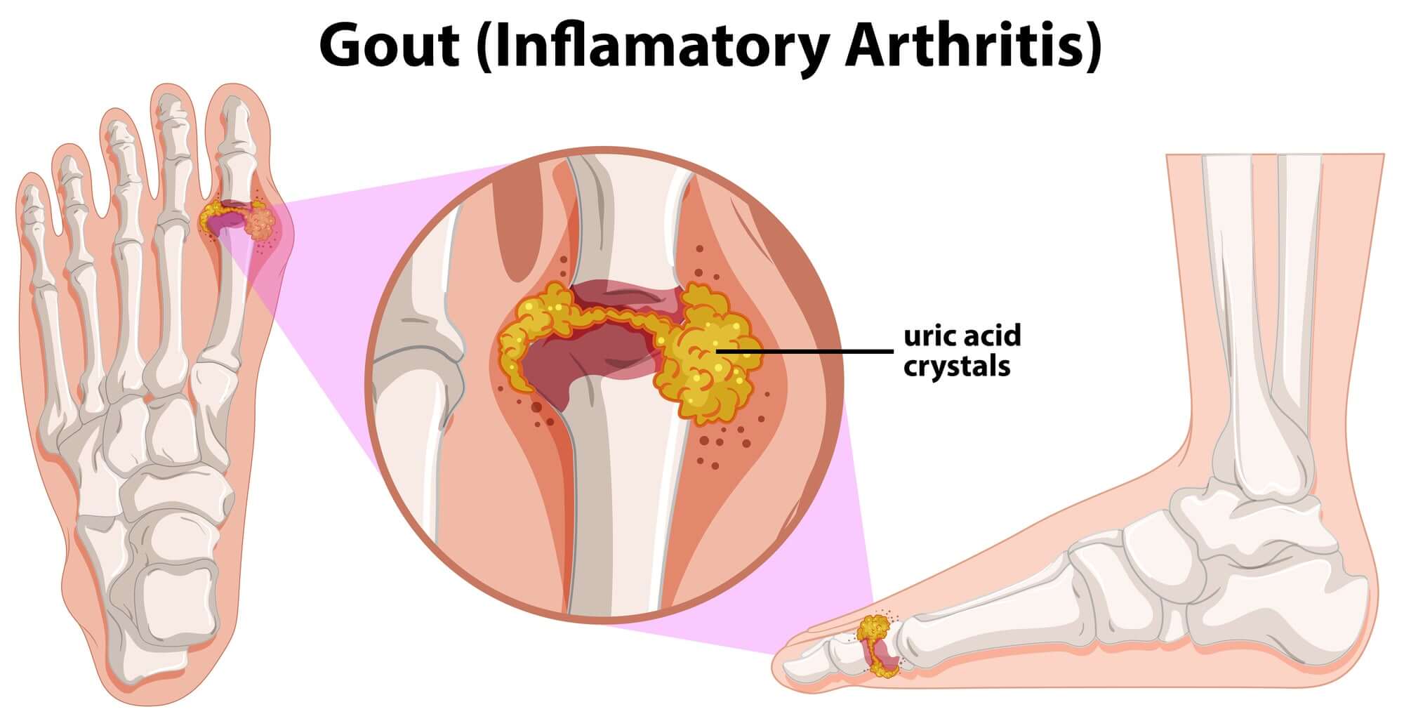 How High Uric Acid Levels Can Unleash Joint Pain Hell