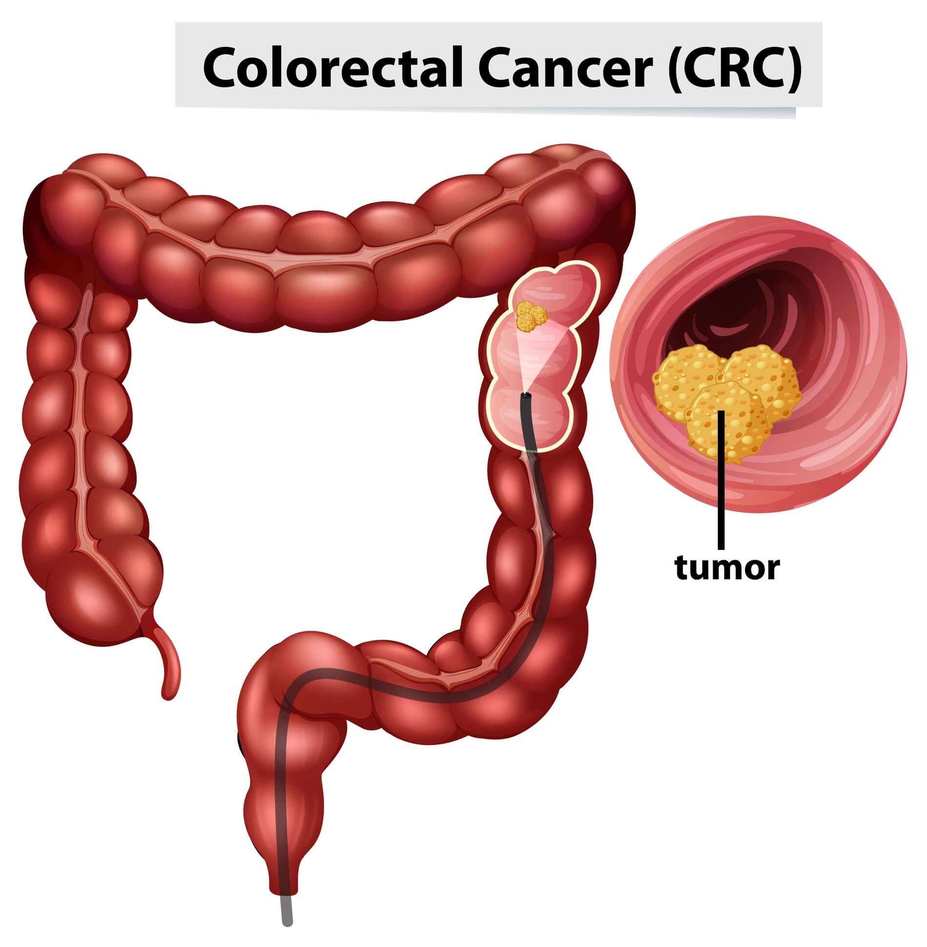 Vitamin D Deficiency and Early-Onset Colorectal Cancer: Unveiling Hidden Health Connections