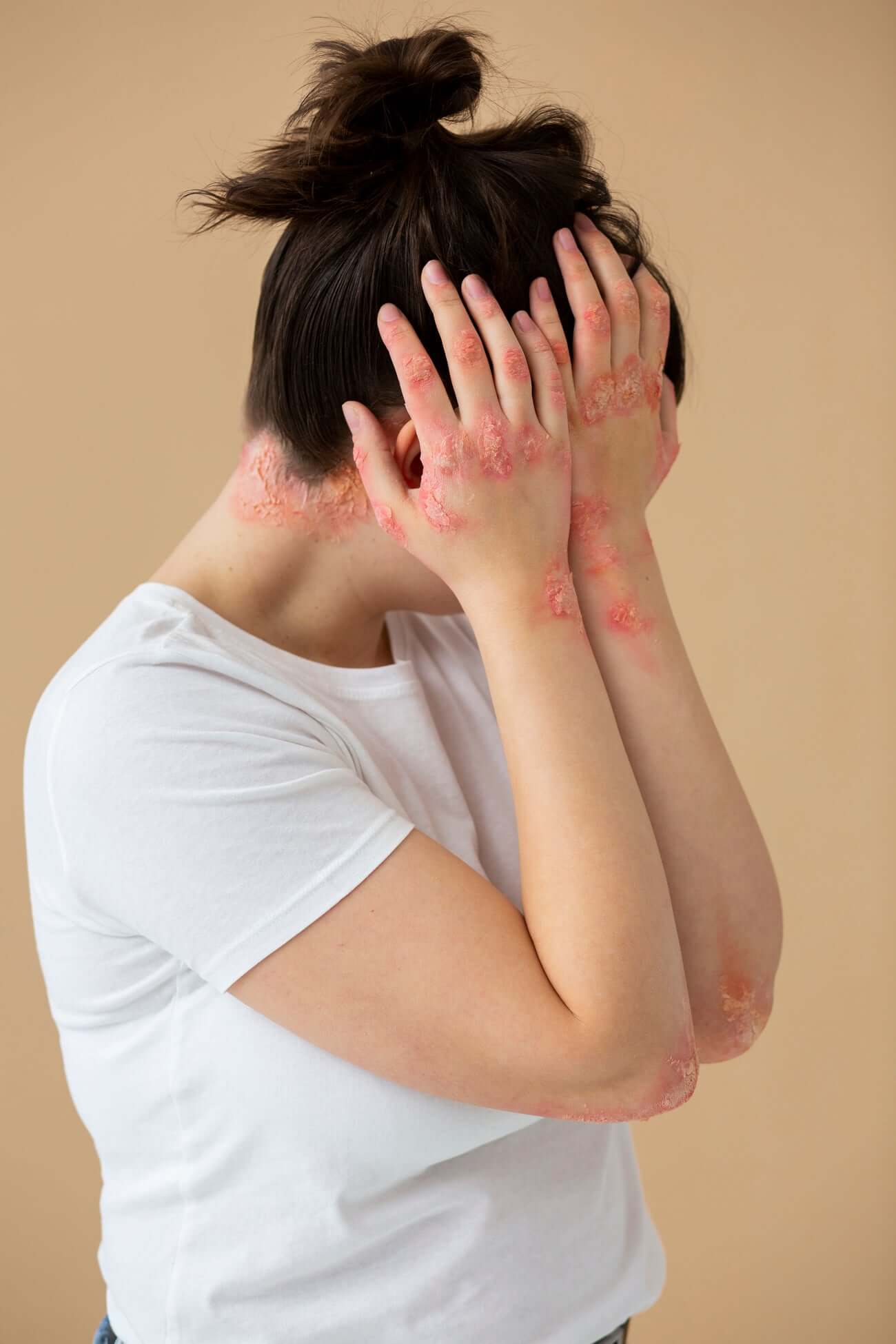 All About Psoriasis You Need To Know