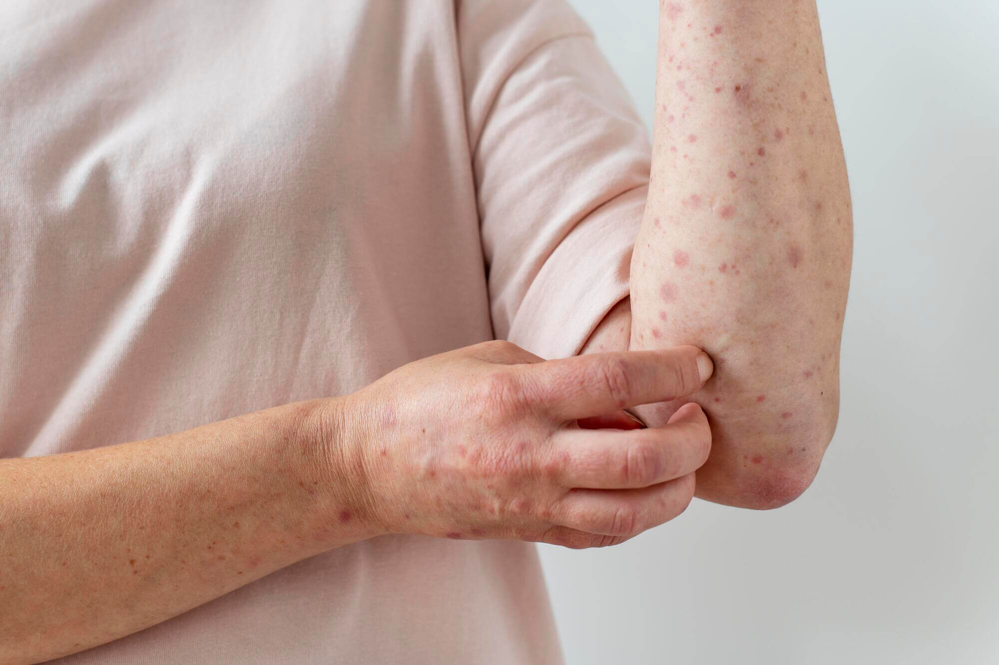 Skin Allergy: Causes, Symptoms, and Treatment