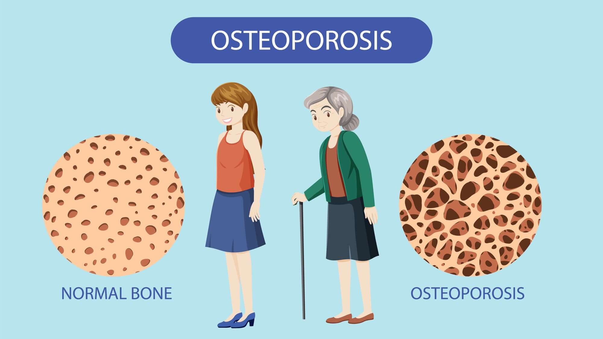 The Ultimate Guide to Supplements for Osteoporosis
