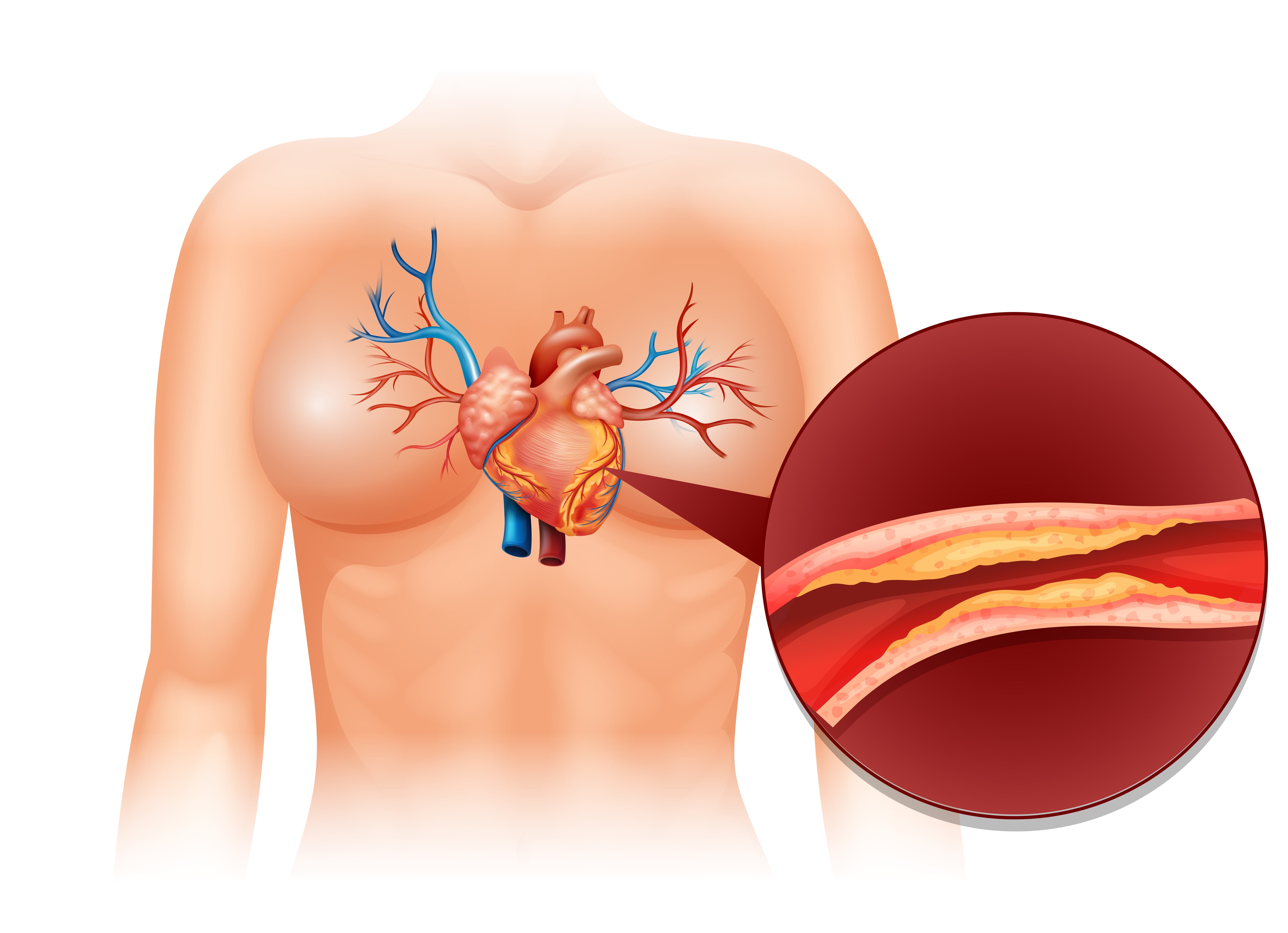 Dyslipidemia: The Silent Risk Factor