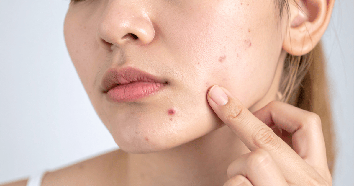 Could This Vitamin Be Making Your Acne Better or Worse?