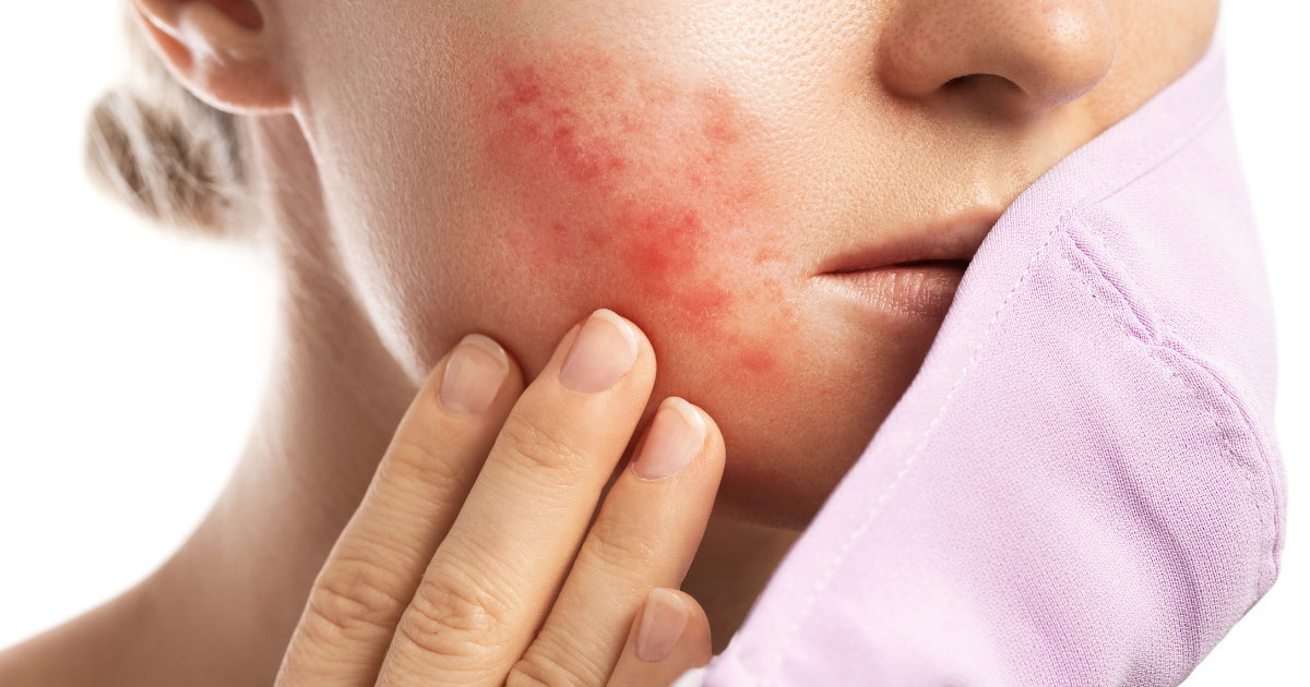 How to Prevent Acne From Wearing a Mask (Maskne)