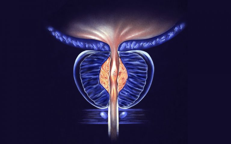 Risk of Benign Prostatic Hyperplasia