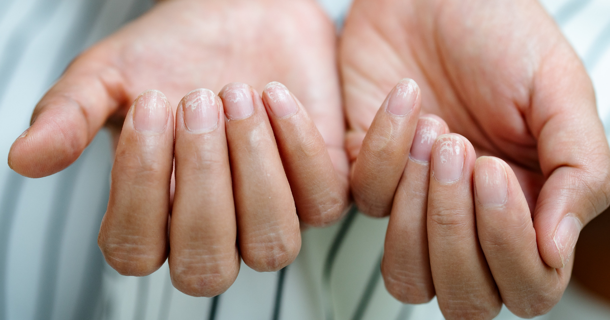 Why Are My Nails So Brittle and Weak?
