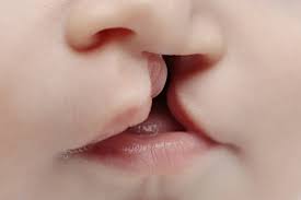 Cleft & Craniofacial: What You Need To Know