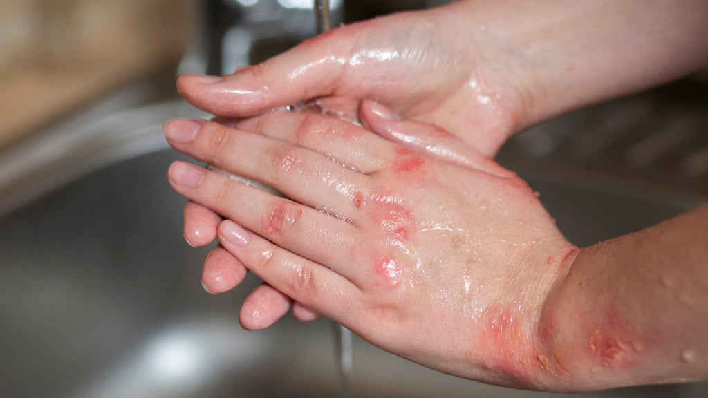 How Your Digestive System Can Affect Your Eczema?