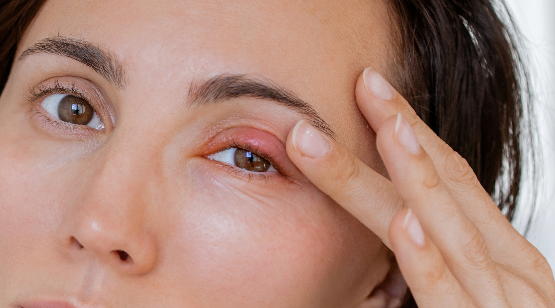 5 Common Eyelid Disorders Type and Their Treatments