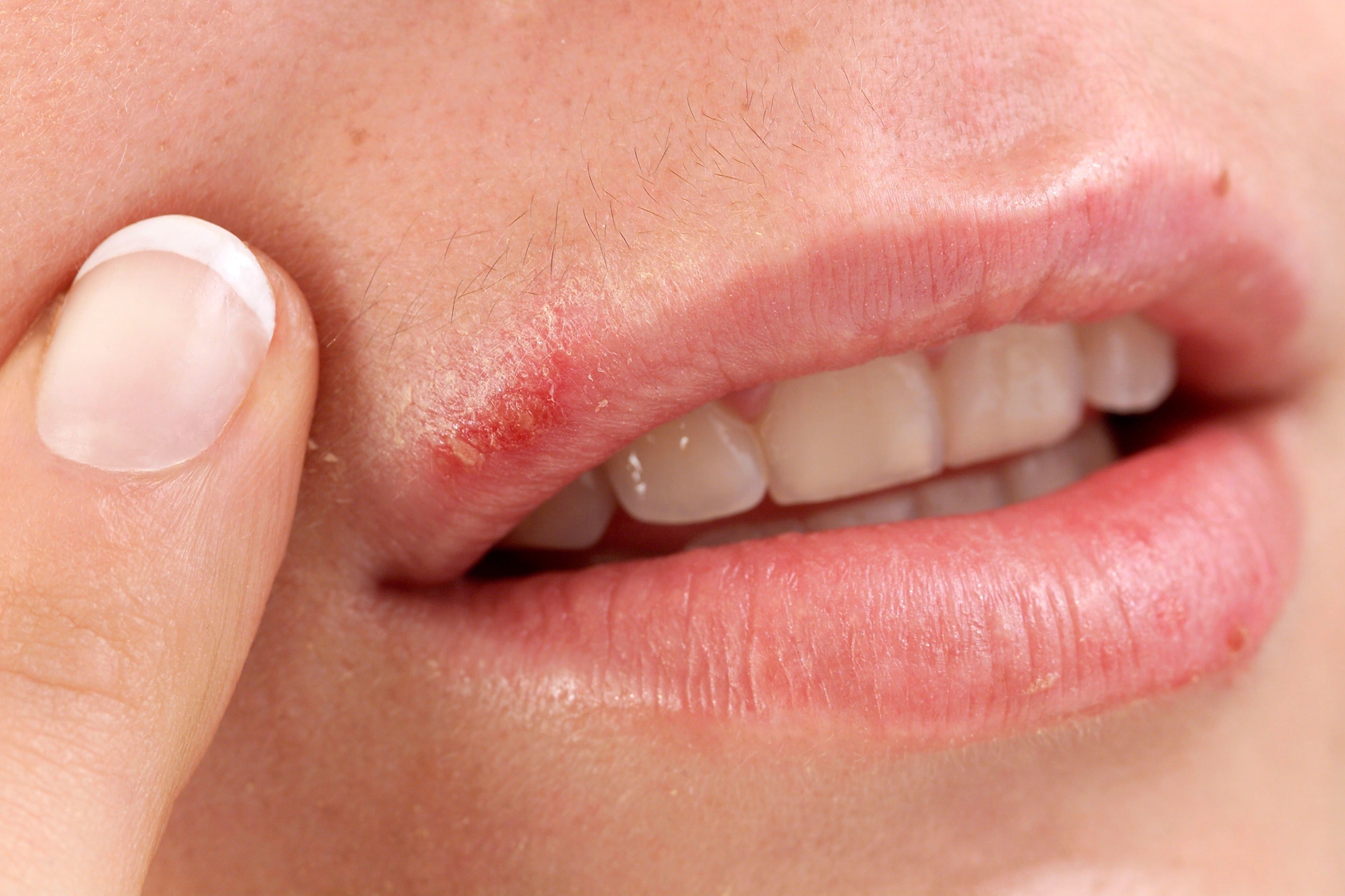 How to Prevent Cold Sores Before They Start