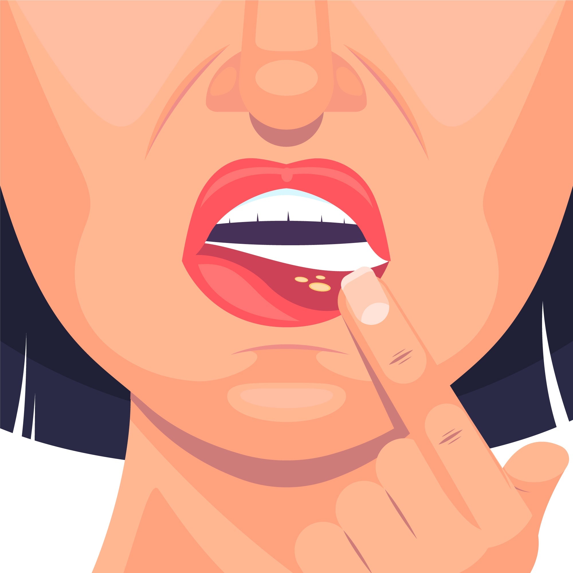 Can Herpes Ever Fully Go Away?