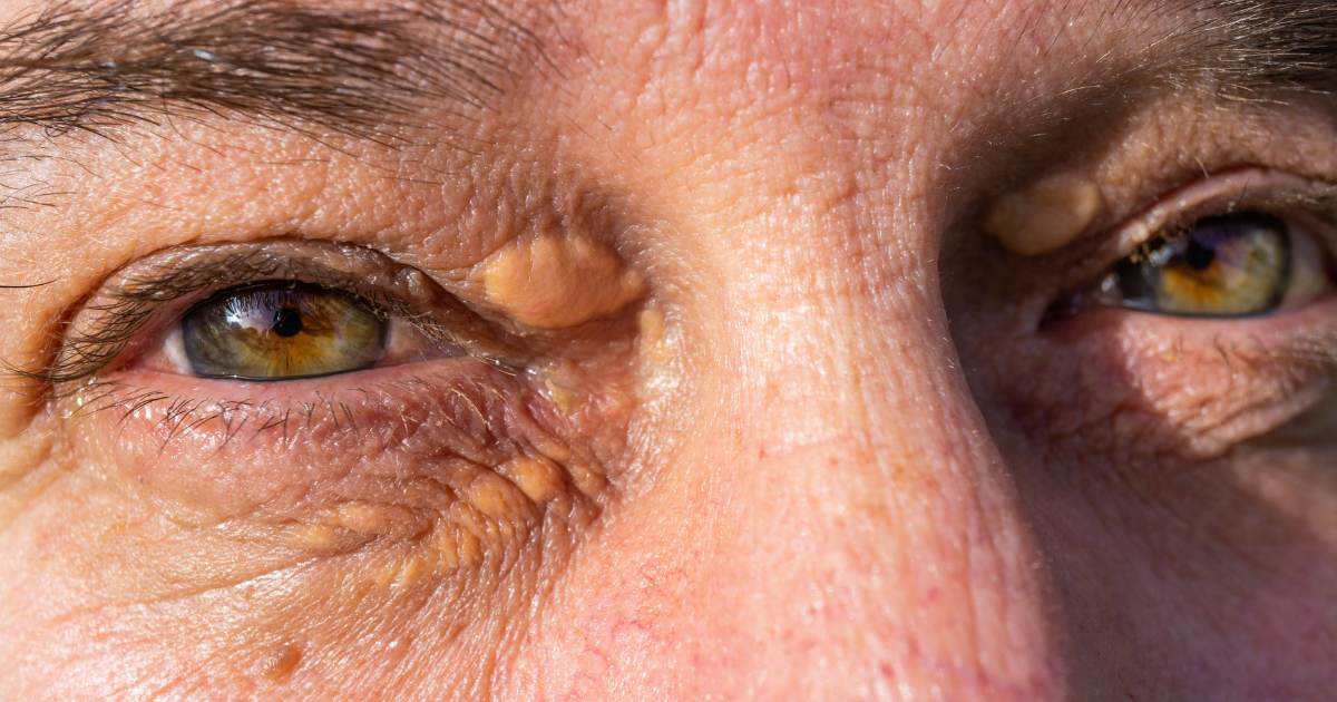 Signs of High Cholesterol on Face