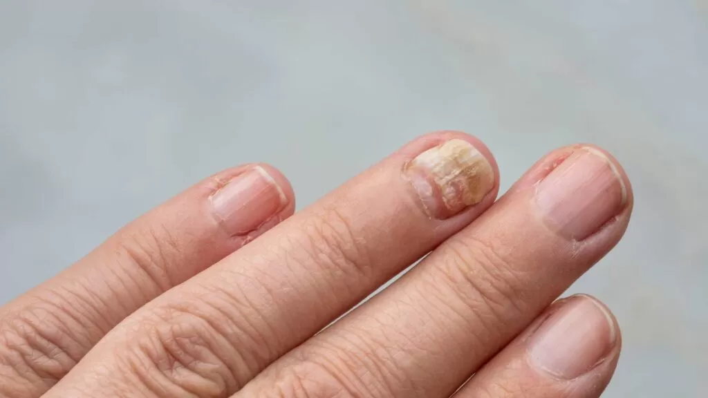 Tea Tree Oil for Nail Fungus: What Does the Science Actually Say?
