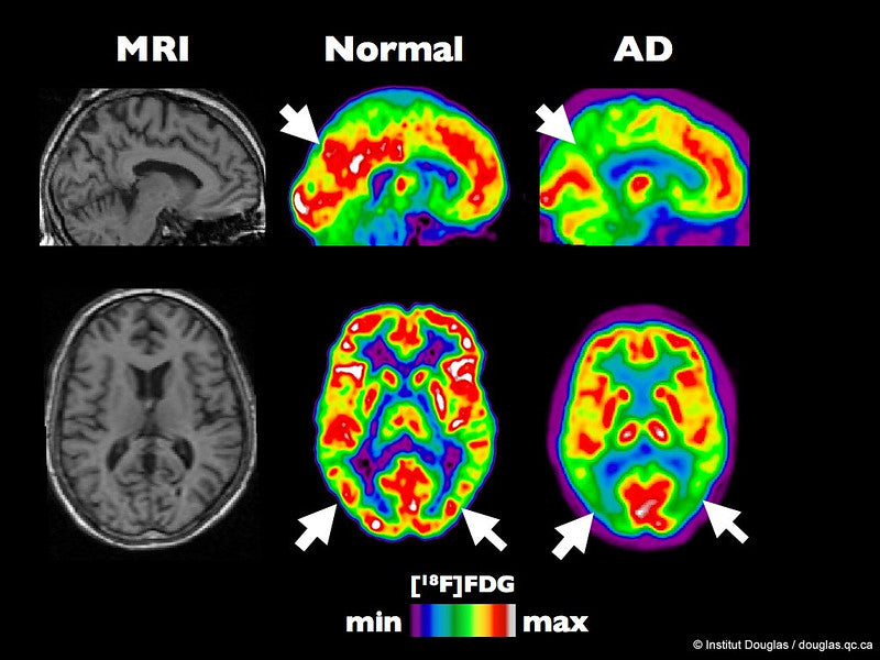 The normal brain vs. brain with Alzheimer’s Disease