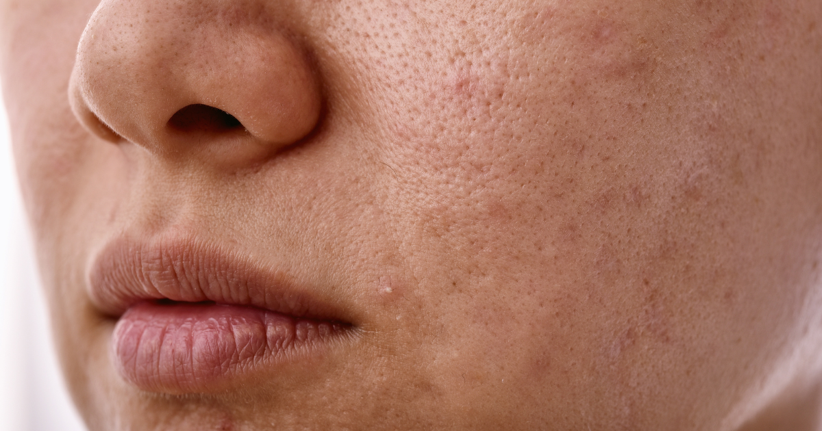 Does Uneven Skin Tone Ever Really Go Away?