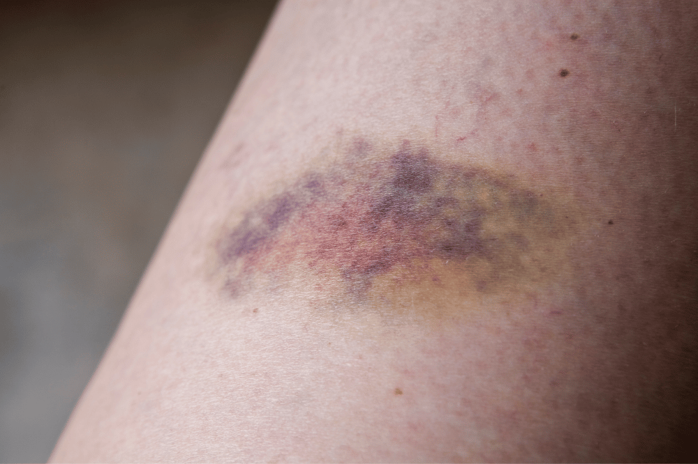 Easy Bruising: What’s Normal and What’s Not