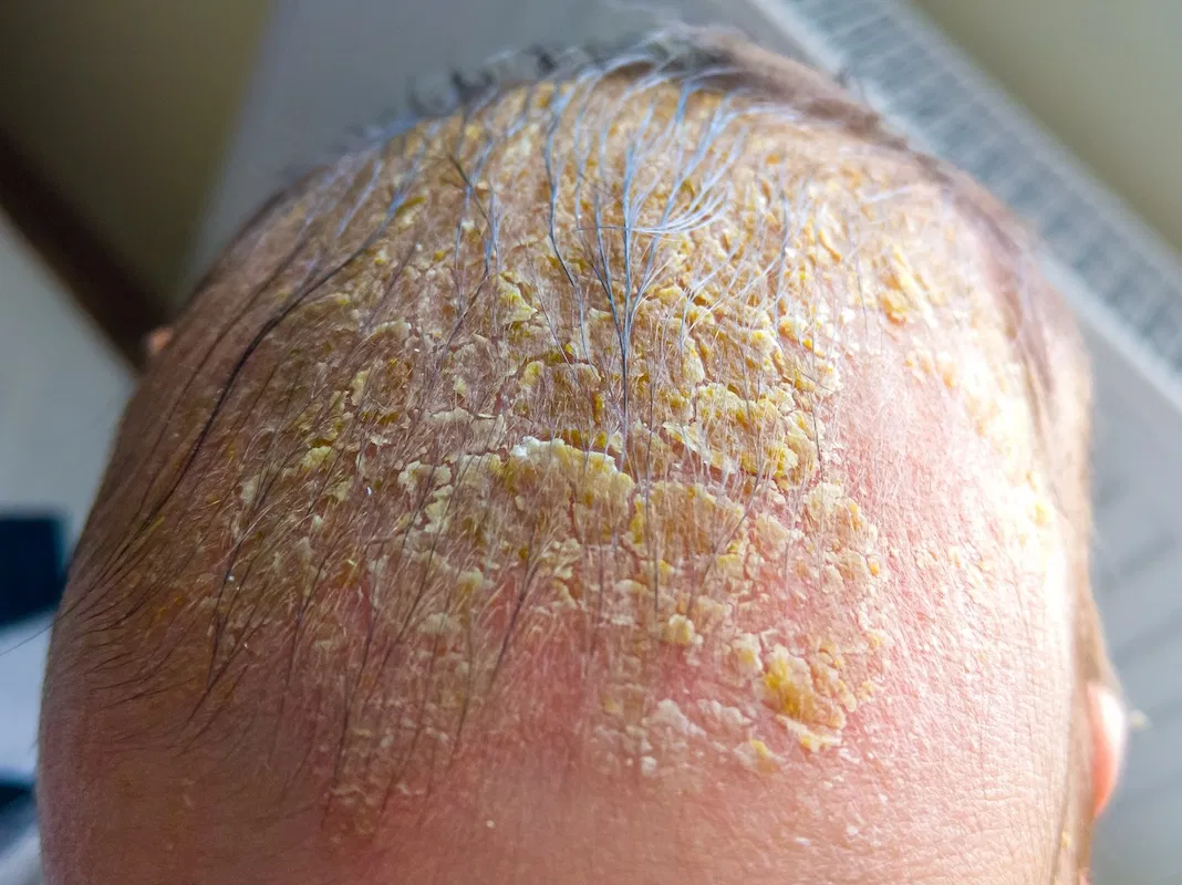 Gentle Solutions for Cradle Cap: What Really Works?