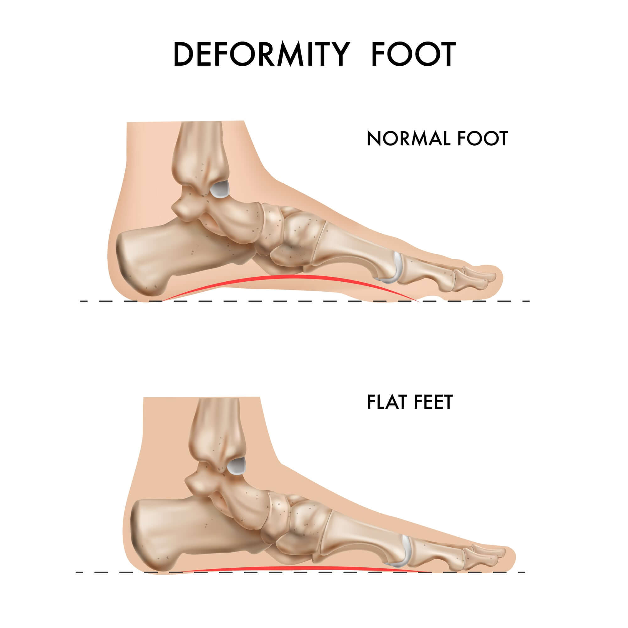 Conquering Flat Feet: Unveiling the Disadvantages and Empowering Solutions