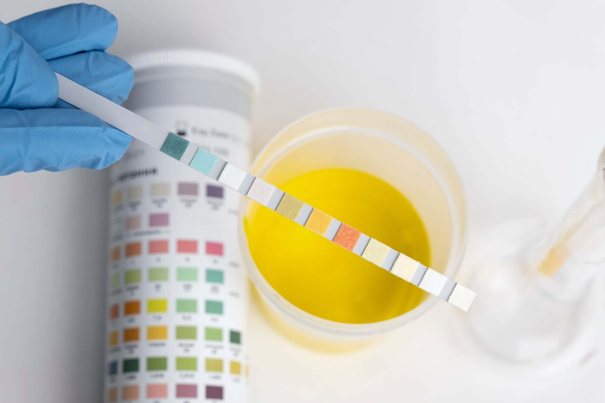 Uric Acid: What You Need to Know