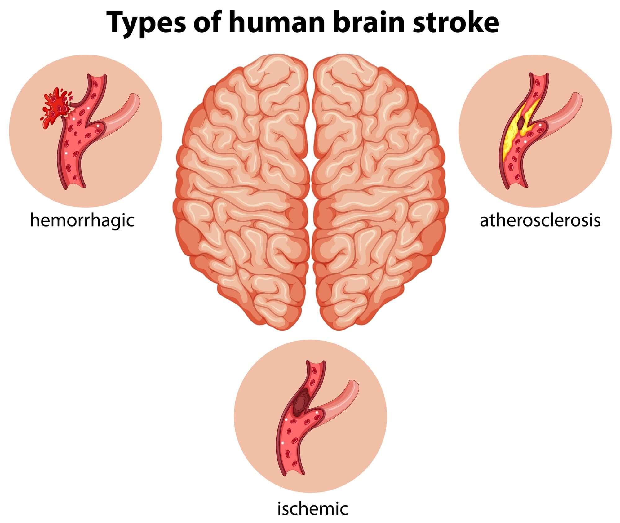 Why Do Strokes Always Happen In The Bathroom?