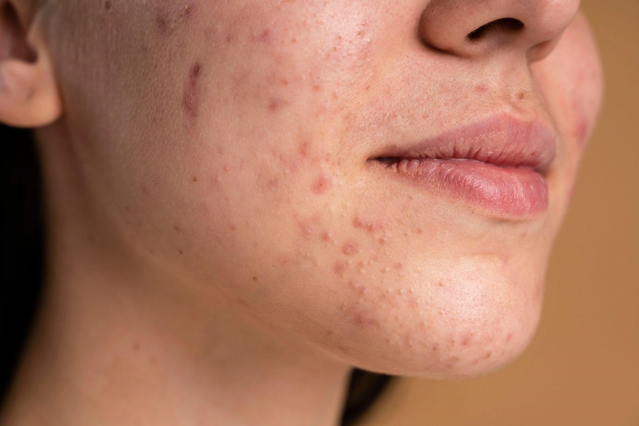 How Niacinamide Fights Acne: Benefits and Tips