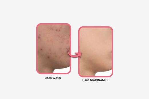 Is Niacinamide Good for Acne – Find Out Here!