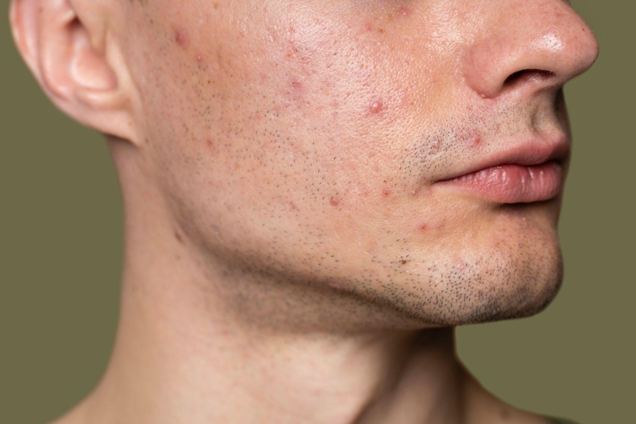 Apple Cider Vinegar for Clear Skin: Skin Savior or Skin Sabotage?