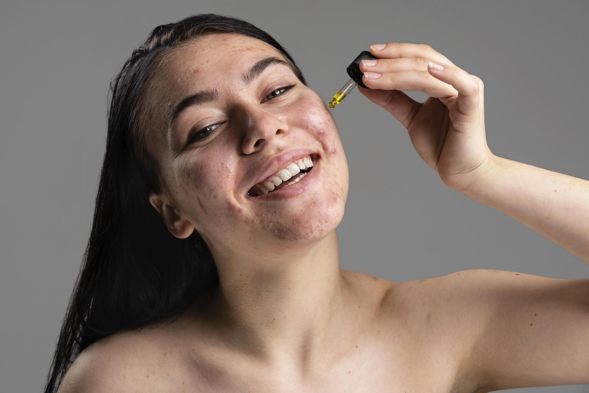 Tea Tree Oil VS Other Natural Acne Treatments | Which Is Best?